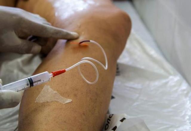 A cada dia, 145 mulheres são internadas para tratar varizes