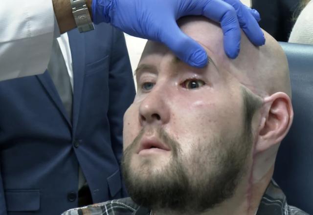 Aaron James, paciente do primeiro transplante de olho inteiro no mundo