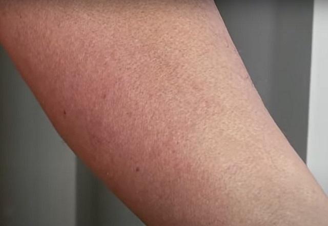 Braço de morador de Pernambuco que relatou coceira, com marcas vermelhas