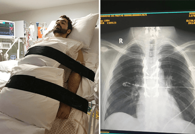 Proteína criada pela UFRJ ajuda pacientes com lesão na medula a recuperar os movimentos Proteína criada pela UFRJ ajuda pacientes com lesão na medula a recuperar os movimentos