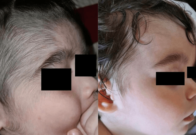 Casos de hipertricose vêm sendo relatados na Espanha após uso de produto anticalvície | Reprodução/Journal Of Dermatology