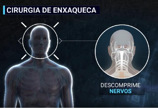 Cirurgia de descompressão de nervos