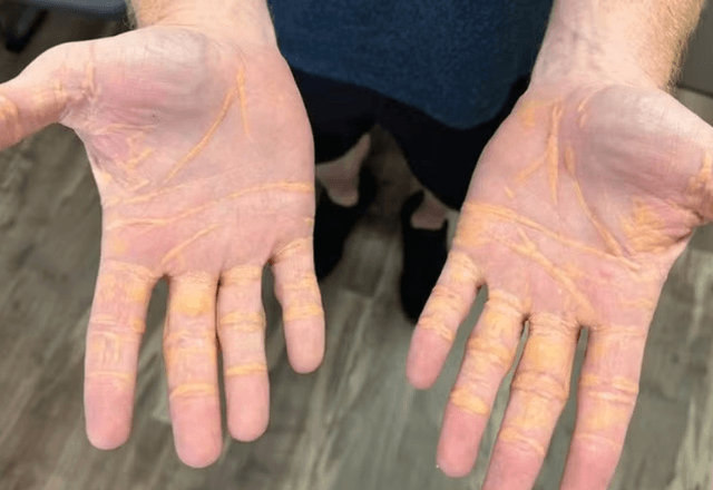 Colesterol "vaza" na mão de homem após dieta carnívora; entenda | Divulgação/JAMA