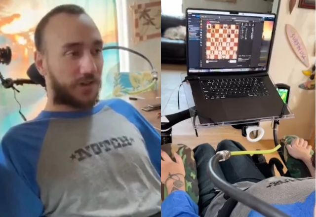 Comunicação do chip com o cérebro foi prejudicada porque os fios do N1 se retraíram | Reprodução/X/@Neuralink