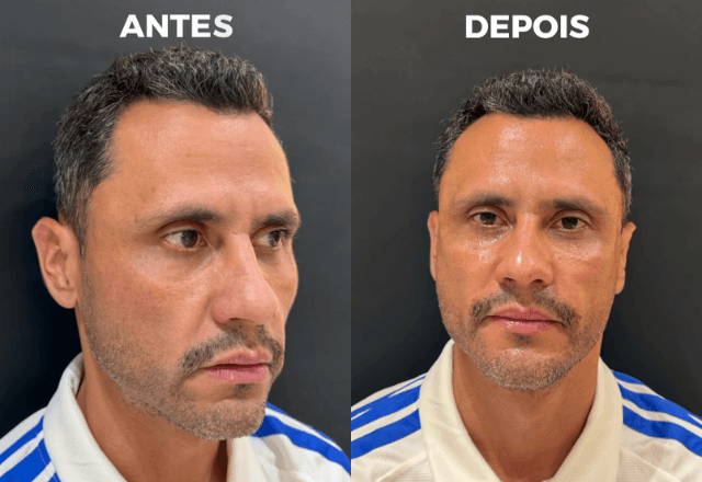 Cleitinho faz procedimentos estéticos após eleição em Minas