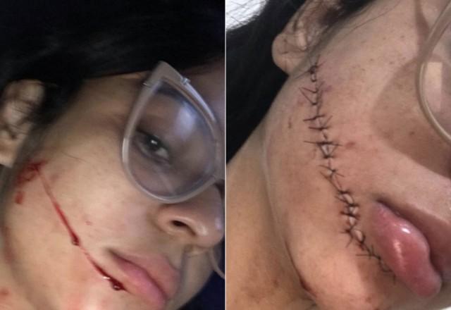 Corte no rosto da jovem atacada