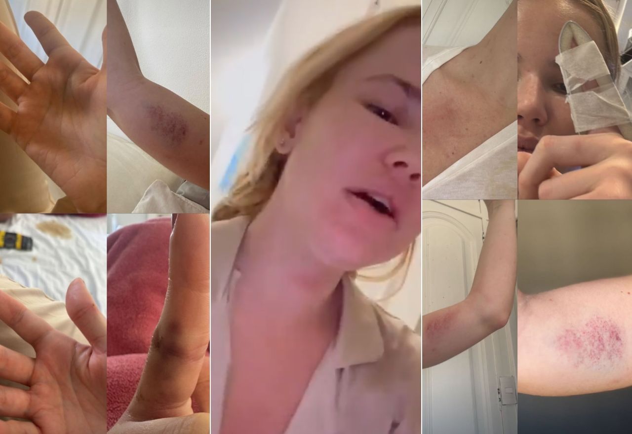 Amiga da modelo publicou imagens em que ela aparece com hematomas pelo corpo | Reprodução/Redes sociais