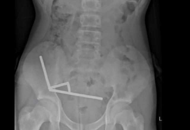 Menino foi internado após quatro dias de dores abdominais | Reprodução/New Zealand Medical Journal