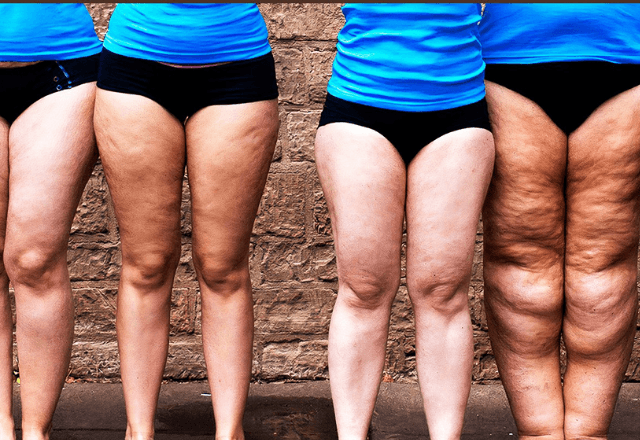 Lipedema: o que fazer quando há acúmulo de gordura nas pernas? | SBT News