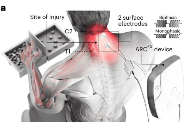 Dos 60 pacientes submetidos a testes, 43 recuperaram os movimentos dos braços e das mãos | Reprodução/Nature Medicine/Onward
