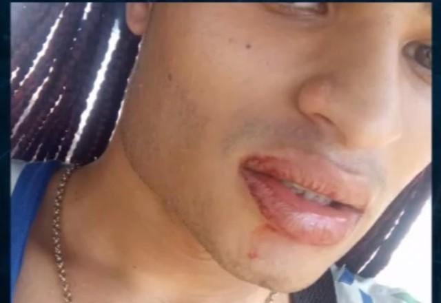 Estudante com boca machucada tira selfie mostrando ferimento