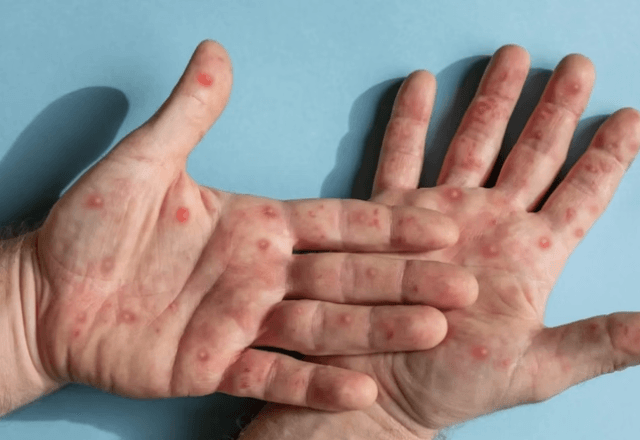 Feridas da Mpox | Freepik