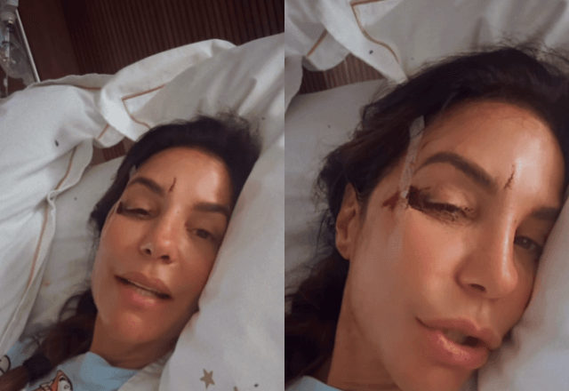 Ivete Sangalo sofre acidente doméstico e mostra machucados no rosto