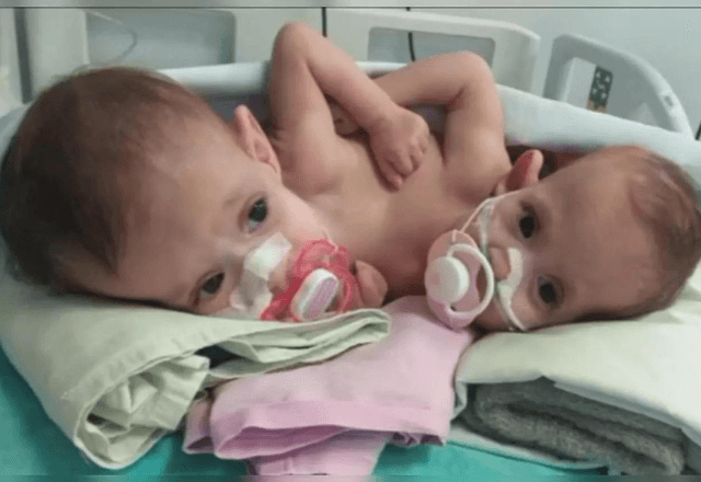 Gêmeas siamesas com três pernas recebem alta hospitalar em Goiânia após 10 meses de internação