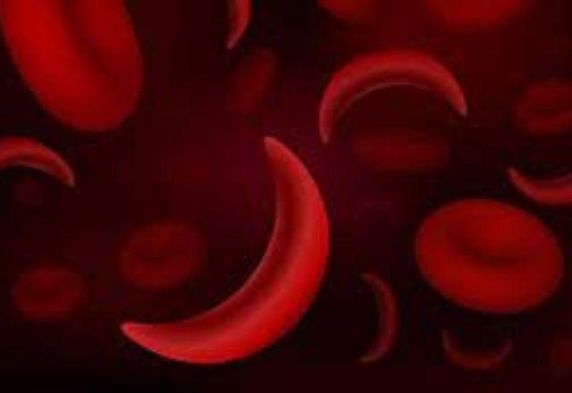 Glóbulos vermelhos com hemoglobina falciforme