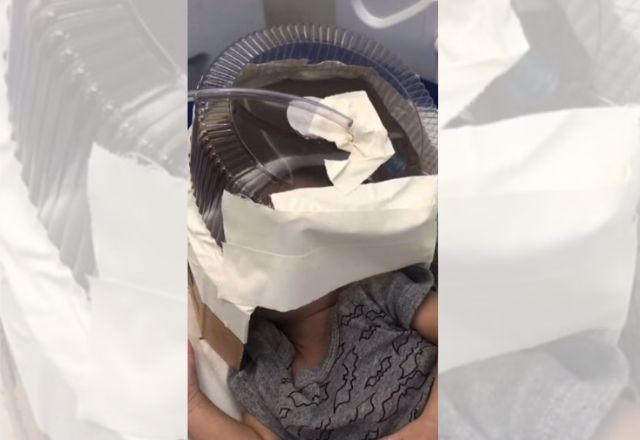 Hospital utiliza embalagem de bolo para improvisar máscara de oxigênio para bebê de três meses | Reprodução/Redes Sociais