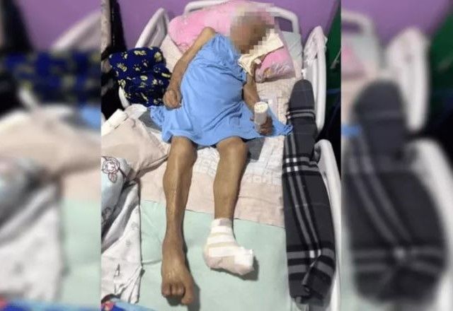 Idosa tem pé amputado sem anestesia em cirurgia | Reprodução