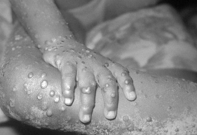 Imagem que mostra uma pessoa contaminada pela varíola dos macacos
