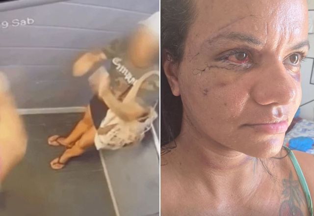 Mulher agredida com 60 socos divulga foto do rosto após cirurgia de reconstrução Mulher agredida com 60 socos divulga foto do rosto após cirurgia de reconstrução