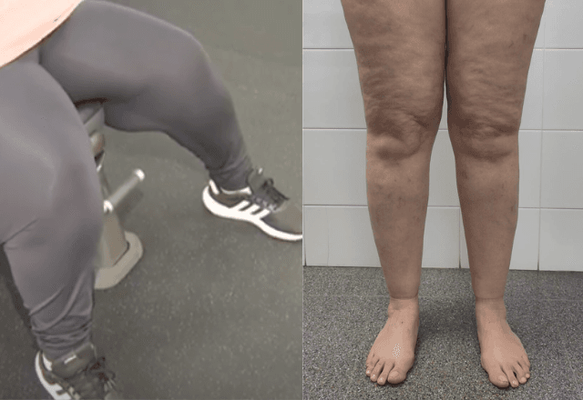 Lipedema: entenda condição | Reprodução/Wiki
