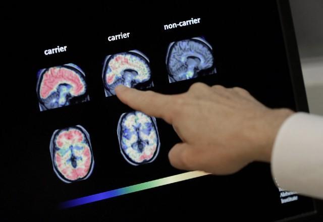 Médico mostra diferença entre um cérebro de uma pessoa com Alzheimer e uma pessoa sem a doença