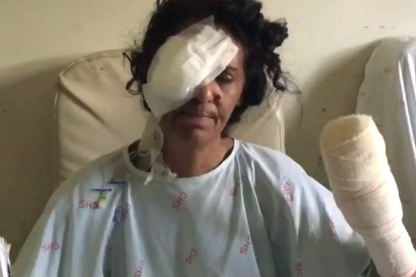 Mulher tem as mãos decepadas e o olho perfurado pelo próprio marido
