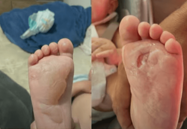 Bebê queima os dois pés em creche no interior de São Paulo