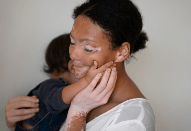 Na maioria das vezes, a vitiligo é uma doença autoimune | Freepik