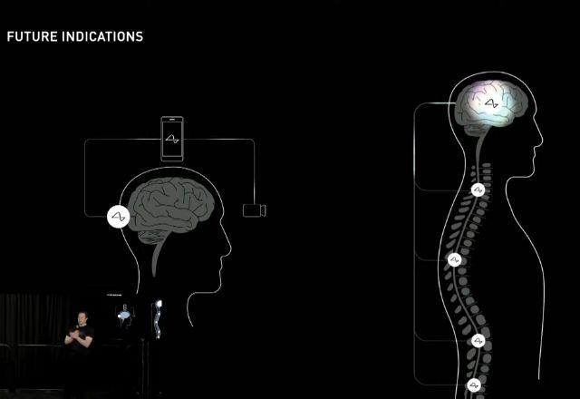 Anúncio foi feito nas redes sociais pelo cofundador da Neuralink, Elon Musk | Reprodução/Neuralink