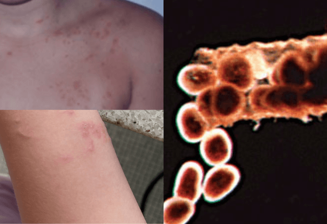 O que é "prurido de trajes banho" ou "piolho-do-mar"? Entenda | Reprodução/Revista Brasileira de Dermatologia e Arquivo Pessoal