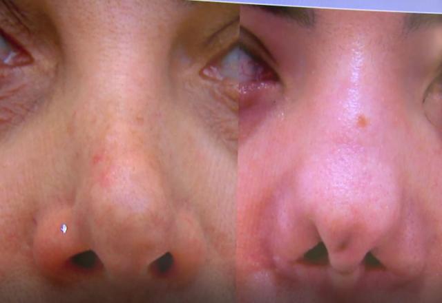 Pacientes sofrem com problemas após cirurgias plásticas