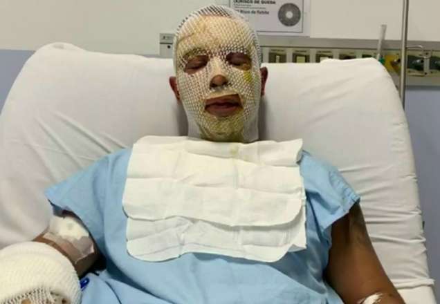 Prefeito de Osasco divulga vídeo após acidente com fogueira em festa Prefeito de Osasco divulga vídeo após acidente com fogueira em festa
