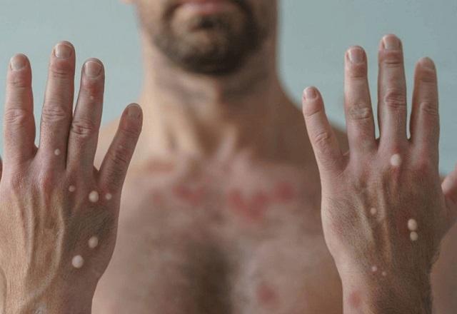 Brasil ultrapassa marca de 1,5 mil casos de Mpox em 2024