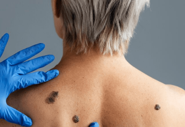 Retorno do melanoma pode ser previsto em exame de sangue | Freepik