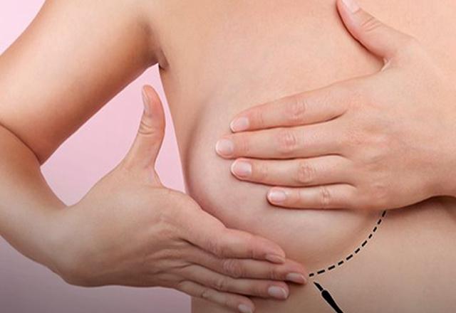 Exame de mamografia ajuda distinguir lesões que não podem ser palpadas |Divulgação/SBM