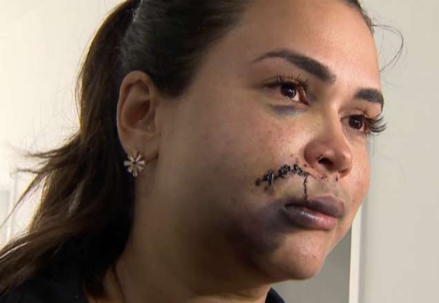 SP: Jovem é agredida dentro de restaurante e fica com o rosto desfigurado SP: Jovem é agredida dentro de restaurante e fica com o rosto desfigurado