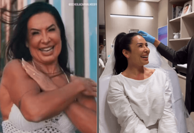 Scheila Carvalho antes e depois do procedimento estético | Reprodução/Instagram