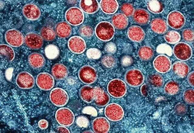 Sintomas da doença incluem febre, dor de cabeça, dores musculares, dores nas costas, adenomegalia, calafrios e exaustão | Divulgação