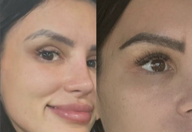 Transplante de sobrancelha: como funciona procedimento feito por Gabriela Cabrini? Transplante de sobrancelha: como funciona procedimento feito por Gabriela Cabrini?