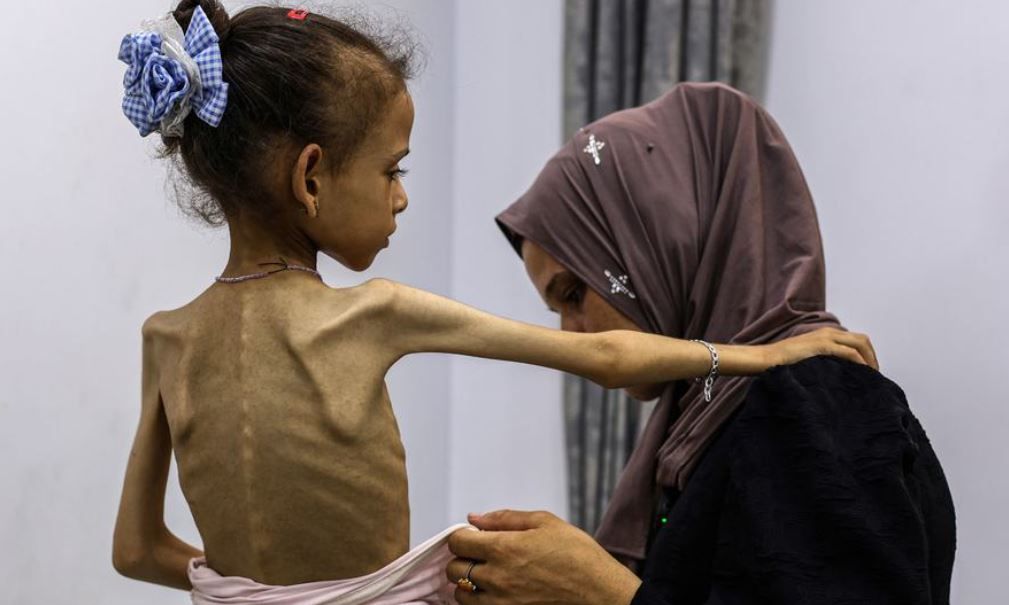 Uma menina gravemente desnutrida em Gaza