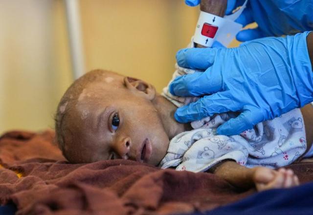 Profissional da saúde segura braço de criança má nutrida (Omid Fazel/Unicef)