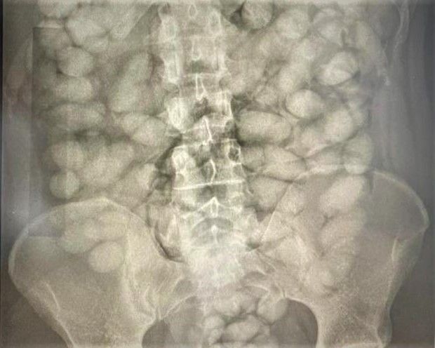Raio X de preso com capsulas de cocaína em Campinas