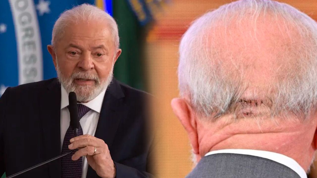 Poder Expresso: Após cirurgia, PT teme que Lula fique fora da disputa de 2026