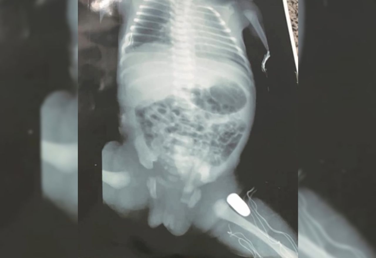 Adolescente grávida é atingida por tiro e bala fica alojada na perna do bebê Adolescente grávida é atingida por tiro e bala fica alojada na perna do bebê