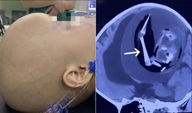 O fetus in fetu (fif) ou gêmeo parasita é uma condição médica extremamente rara | American Journal Case Reports / Divulgação