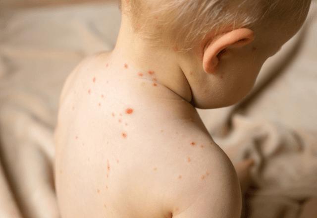 Bebê de 1 ano e 2 meses é diagnosticado com sarampo | Reprodução Freepik