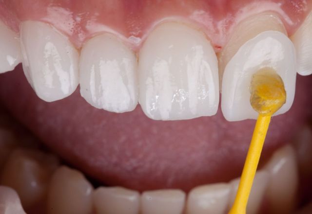 Venda de resinas em e-commerce é alvo de denúncia do Conselho de Odontologia Venda de resinas em e-commerce é alvo de denúncia do Conselho de Odontologia