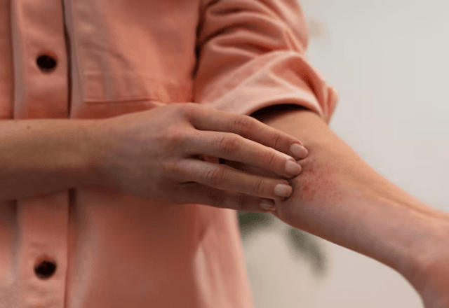 Dermatite utópica | Reprodução Freepik