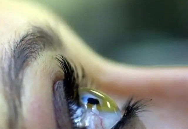 Imagem ilustração, glaucoma. (Reprodução/ Agência Brasil)