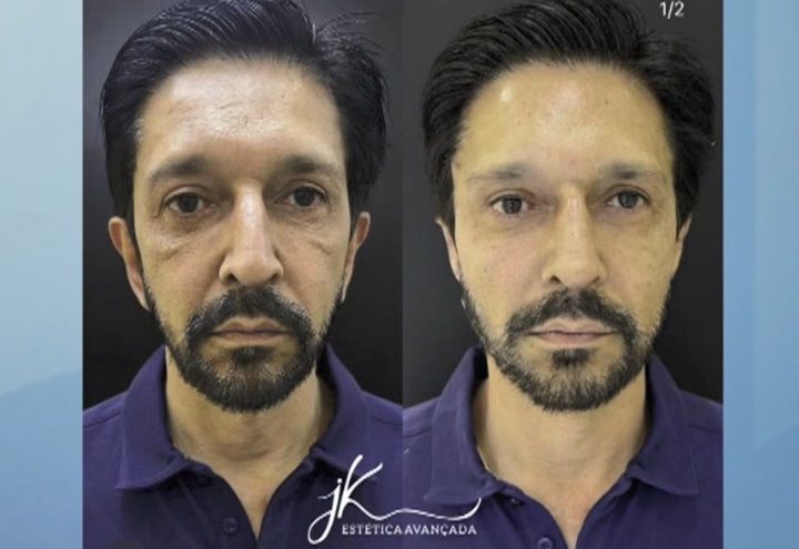 Harmonização facial de Ricardo Nunes (MDB) pode motivar investigação